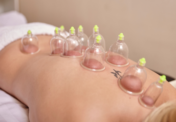Dry Cupping